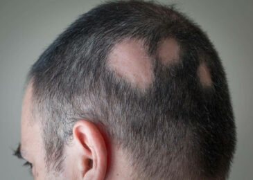 5 Common Hair-Thinning and Hair-Loss Myths for Men Exposed